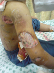 Chemical burns on a 15 year old Palestinian child following Israeli bombings in the village of Khoza'a, Gaza