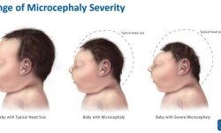 CDC: No Doubt Zika Virus Causes Microcephaly and Birth Defects